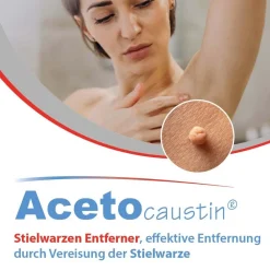Acetocaustin Stielwarzen Entferner Stift><noscript><img width=