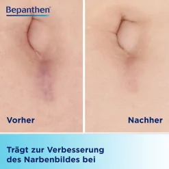 BepanCare Narben-Gel mit Massage-Roller – macht Narben glatter, flacher und weicher><noscript><img data-lazyloaded=