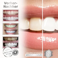 Dental Beauty Zahnbleaching-Set US-Whitening Technologie Rapid+><noscript><img width=