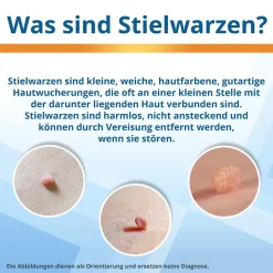 EXTRA: Stielwarzen entfernen, Vereisungsmittel zur Entfernung von Stielwarzen an Hals, Brust & Achseln><noscript><img width=