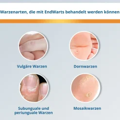 FREEZE: Vereisungsmittel zur Entfernung von Warzen an Händen, Armen & Füßen|EndWarts Best