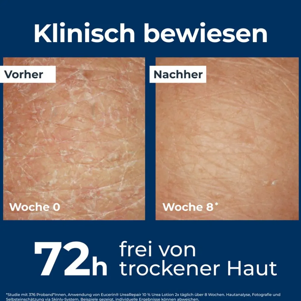 ® UreaRepair 10% Urea Intensive Feuchtigkeitslotion – Körperlotion für sehr trockene bis extrem trockene Haut - Jetzt 20 % mit dem Code 20 sparen|Eucerin Online