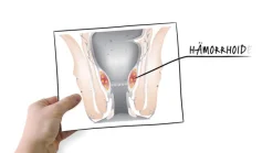 ® Hämorrhoidenzäpfchen + ® Feuchtpflegetücher + ® Hämorrhoidensalbe mit Applikator|Hametum Clearance
