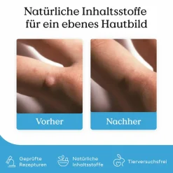 Wart Care Pen / Bei Warzen|Health Routine