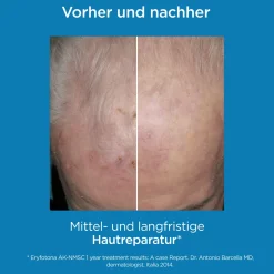 Eryfotona AK Medizinprodukt zur Prävention und unterstützenden Behandlung aktinischer Keratosen und hellem Hautkrebs (NMSC)|ISDIN Sale
