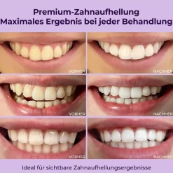 Onlysmile® All-in-One Bundle – Zahnbleaching Set, Gel, Zahnpulver & 2x Zahnpasta><noscript><img width=