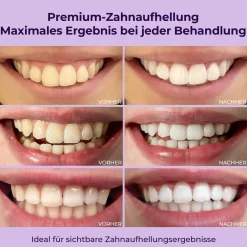 OnlySmile® Zahnaufhellung Bleaching Gel><noscript><img width=