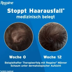 Regaine Männer Lösung mit Minoxidil bei erblich bedingtem Haarausfall><noscript><img width=