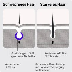 SONS Minoxidil 50mg/ml Lösung & Derma Roller für Männer bei erblich bedingtem Haarausfall> Online