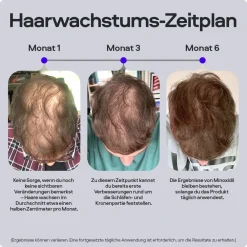 SONS Minoxidil 50mg/ml Lösung & Derma Roller für Männer bei erblich bedingtem Haarausfall><noscript><img width=
